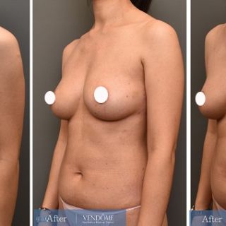 療程效果因人而異，上圖為D罩杯卻乳房下垂的女性在做完自體脂肪隆乳之後​手術後一個月、手術後八個月成效